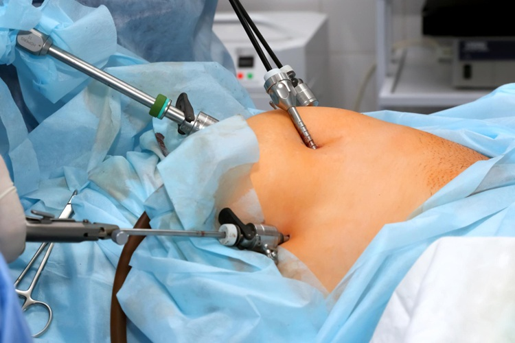 Laparoscopic Hernia Surgery